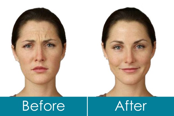 ranelagh dental botox before after Ranelagh Dental Clinic - botox treatment before and after