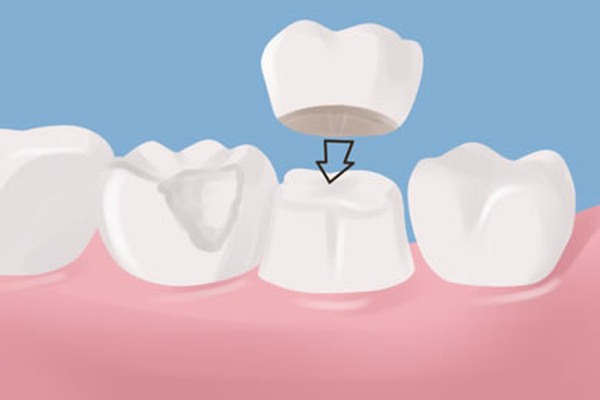 dental crowns