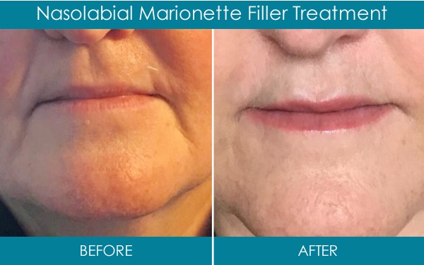 Ranelagh Dental Dermal Fillers - Nasolabial marionette filler treatment