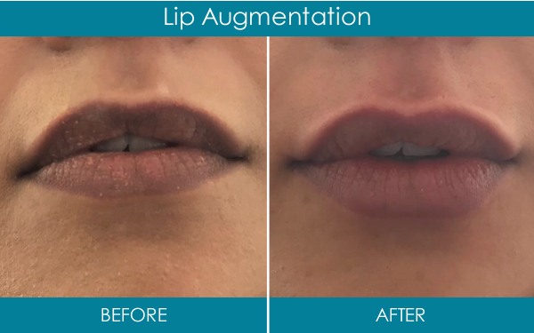 Ranelagh Dental Dermal Fillers - lip augmentation dublin