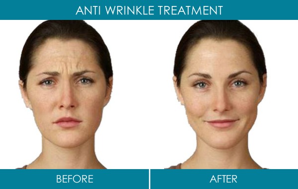 Ranelagh Dublin Clinic - Anti Wrinkle treatment before and after - reduce wrinkles