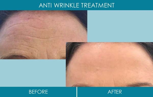 Ranelagh Dublin Clinic - Anti Wrinkle treatment before and after - reduce wrinkles